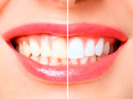 Blanqueamiento dental con técnica innovadora ¡Luce una sonrisa radiante!