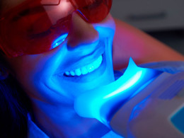 Blanqueamiento dental con técnica innovadora ¡Luce una sonrisa radiante!