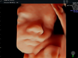 Ecografía con visualización 5D ¡Descubre a tu bebé como nunca antes!